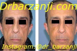 تزریق چربی صورت