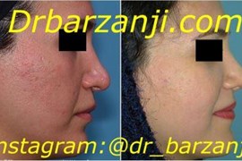 جراحی ترمیمی بینی چهار ماه بعد از عمل