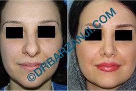 جراحی بینی یک سال بعد از عمل