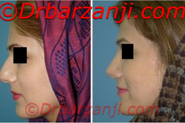 عکس قبل و بعد جراحی پلاستیک بینی شش ماه بعد