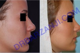 جراحی بینی، یک سال بعد از عمل