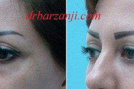 تزریق ژل بلوترو در فرورفتگی زیر چشم