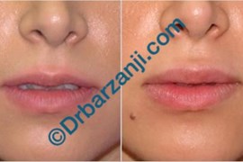 تزریق ژل جوویدرم  ( ژوویدرم ) به لب