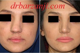جراحی بینی کج