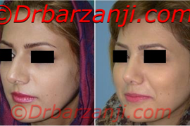 عکس قبل و بعد جراحی پلاستیک بینی شش ماه بعد