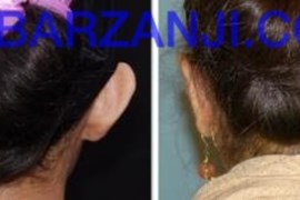 عمل جراحی پلاستیک لاله گوش