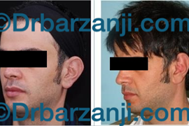 عمل جراحی پلاستیک برجستگی لاله گوش