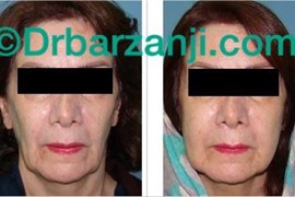 تزریق چربی صورت