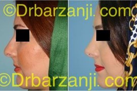عمل جراحی زیبایی بینی یک سال بعد