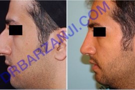 جراحی بینی، شش ماه بعد از عمل