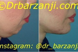 پروتز چانه و لیپوساکشن غبغب