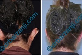 جراحی برجستگی لاله گوش