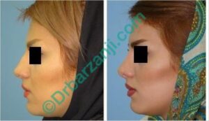 جراحی پلاستیک بینی شش ماه بعد از عمل
