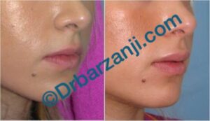 تزریق ژل جوویدرم ( ژوویدرم ) به لب