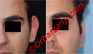 جراحی برجستگی گوش یک ماه بعد از عمل