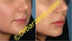 تزریق ژل در لب