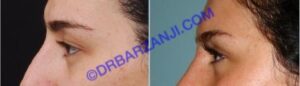 جراحی پلک بالا، 6 ماه بعد