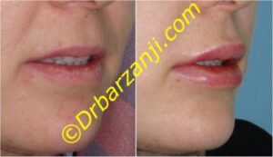 تزریق ژل لب ها