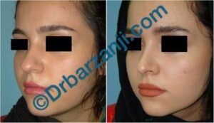 جراحی پلاستیک بینی نه ماه بعد از عمل
