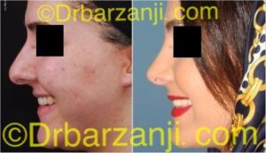 عمل جراحی زیبایی بینی یک سال بعد
