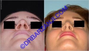 جراحی پلاستیک بینی، 4 سال بعد