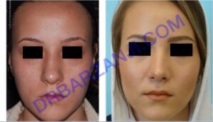 جراحی بینی، یک سال بعد از عمل