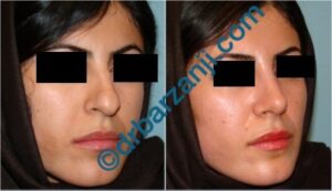 جراحی بینی یک ماه بعد از عمل
