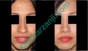 یک سال بعد از جراحی پلاستیک بینی