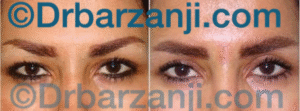 جراحی پلاستیک پلک بالا