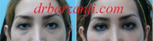 تزریق چربی در فرورفتگی زیر چشم ها