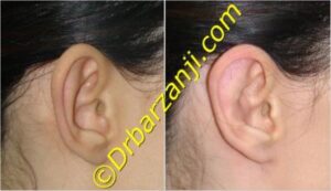 جراحی برجستگی لاله گوش