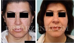 لیفت صورت و گردن