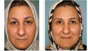 عمل جراحی پلک (بلفاروپلاستی) فوقانی