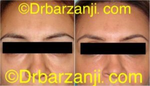 تزریق چربی زیر چشم ها