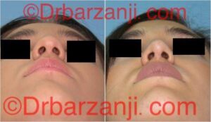 عکس عمل جراحی پلاستیک بینی ۶ ماه بعد