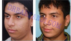 پروتز چانه و جراحی بینی، ٣ هفته بعد از عمل