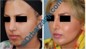 پروتز چانه و گونه سه هفته بعد از عمل