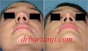 جراحی بینی کج