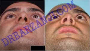 عمل جراحی پلاستیک بینی ٢ سال بعد