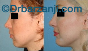 پروتز چانه و گونه دو ماه بعد از عمل