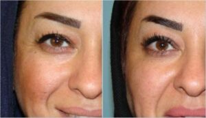 بهبودی خطوط کنار چشم با تزریق دیسپورت