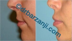 تزریق ژل لب (جوویدرم )