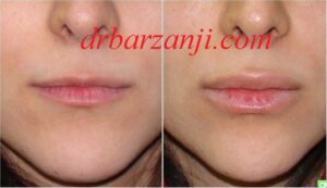 تزریق فیلر ژوویدرم در لب