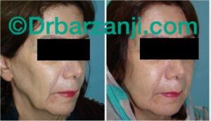 تزریق چربی صورت