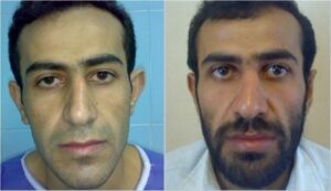 جراحی لاله گوش- روبرو