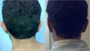 جراحی لاله گوش- پشت سر