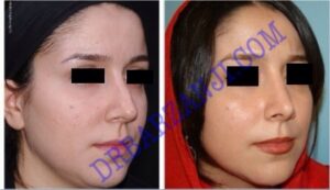 جراحی بینی ، ۶ ماه بعد از عمل