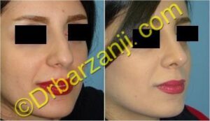 جراحی بینی سه ماه بعد از عمل