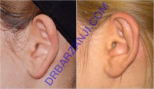 عمل جراحی لاله گوش برجسته
