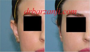 جراحی زیباییی لاله گوش ( اتوپلاستی )
